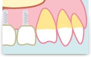 ご存知ですか?インプラント治療