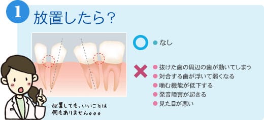 1)放置したら?○●なし ×●抜けた歯の周辺の歯が動いてしまう●対合する歯が浮いて弱くなる●噛む機能が低下する●発音障害が起きる●見た目が悪い