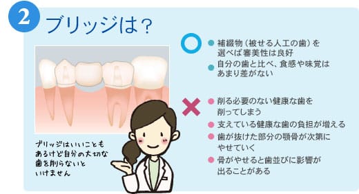 2ブリッジは? ○●補綴物(被せる人工の歯)を選べば審美性は良好●自分の歯と比べ、食感や味覚は●あまり差がない ×●削る必要のない健康な歯を●削ってしまう●支えている健康な歯の負担が増える●歯が抜けた部分の顎骨が次第に●やせていく●骨がやせると歯並びに影響が●出ることがある