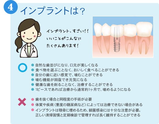 4インプラントは? ○●自然な歯並びになり、口元が美しくなる●食べ物を選ぶことなく、おいしく食べることができる●自分の歯に近い感覚で、噛むことができる●噛む機能が回復でき元気になる●健康な歯を削ることなく、治療することができる ×●歯を抜く場合と同程度の手術が必要●体質や疾病(重度の糖尿病など)によっては治療できない場合がある●インプラントは顎骨に埋めるため、細菌感染には十分な注意が必要。●正しい清掃習慣と定期検診で管理すれば長く維持することができる●1ピースであれば治療から通常約1ヶ月で、噛めるようになる