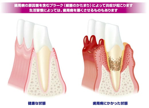 歯周病の原因菌を含むプラーク(細菌のかたまり)によって炎症が起こります 生活習慣によっては、歯周病を悪くさせるものもあります 左:健康な状態 右:歯周病にかかった状態